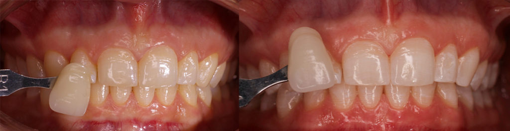 Hampaiden valkaisu ennen ja jälkeen